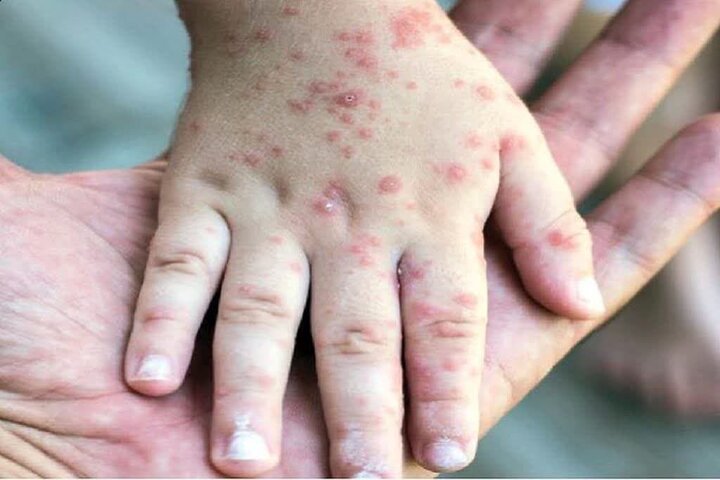 افزایش چشمگیر سرخک در افغانستان افزایش چشمگیر سرخک در افغانستان